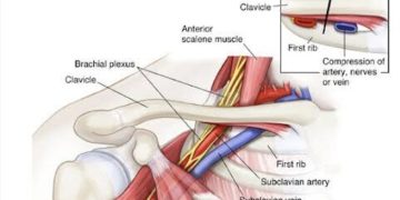 What is Thoracic Outlet Syndrome (TOS)?